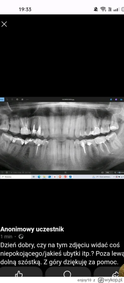enjoy10 - Witam, czy na tym zdjęciu widać cos niepokojącego/jakieś ubytki? 
#stomatol...
