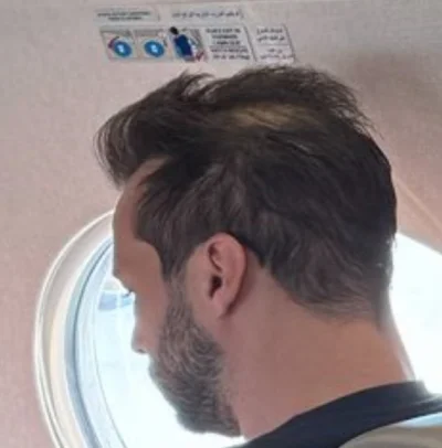 kastrator2 - Chłop po przeszczepie #lysienie