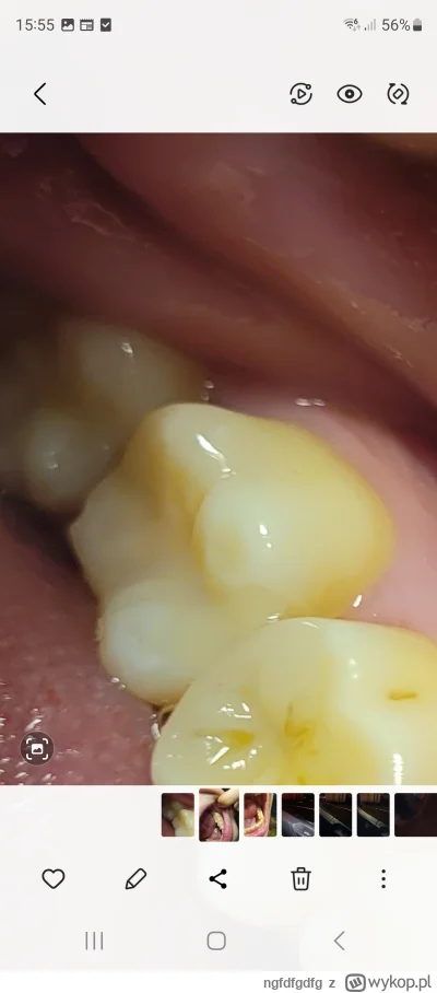 ngfdfgdfg - Da się stwierdzić od czego ten uszczerbek na  guzku 7 ? 
Bruksizm czy wad...