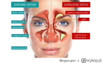 Megasuper - Miał ktoś z was tak #!$%@? zatoki że twarz wam pulsowała i bolała po np k...