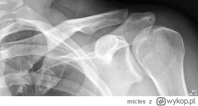 micles - Czy kształt tego obojczyka jest ok? #ortopedia #lekarz