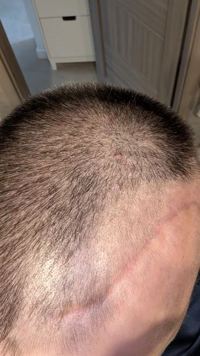 6poziomprokrastynacji - #6poziomraka, cala historia.

Elo,
Wlosy mi zaczynaja odrasta...