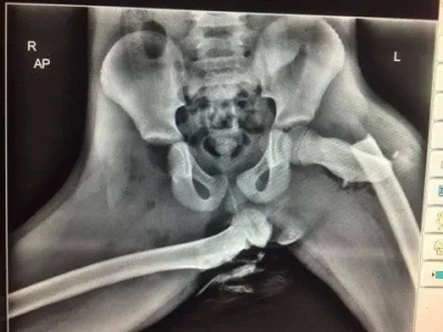 DzonySiara - Zdjęcie rentgenowskie kobiety po wypadku samochodowym, która miała nogi ...