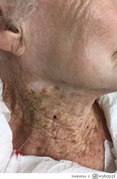 tonkatsu - @4833478: tutaj zdjęcie 92 letniej kobiety która używała spf na twarzy, al...