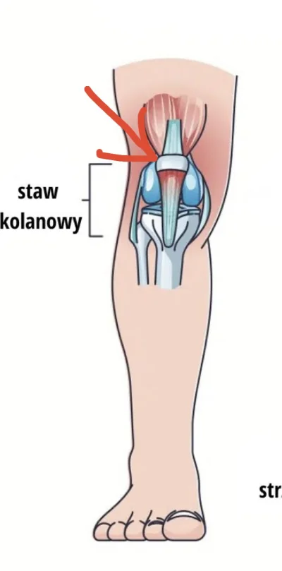 zar0x - Mam problem z kolanem - boli mnie w miejscu zaznaczonym na obrazku (górny zew...