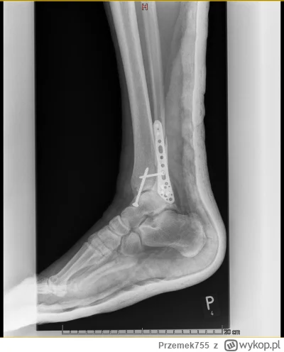 Przemek755 - czy noga z zarośniętym już tytanem, jest mocniejsza czy słabsza niż była...