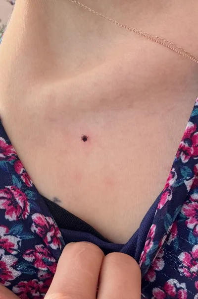 Historycznygagatek - @chione: 2 miesiące temu wyciągałam takimi łapkami kleszcza z ok...