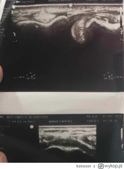 kaloszer - Czy to ECU subluxation? Miałem wywrotke na rowerze - złamanie z przemieszc...