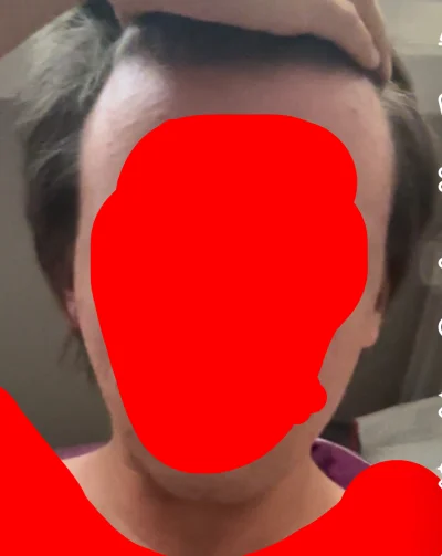 kamileon25 - Kolejny dzień męczarni której źródło znajduje się na końcu mojej szyi. K...