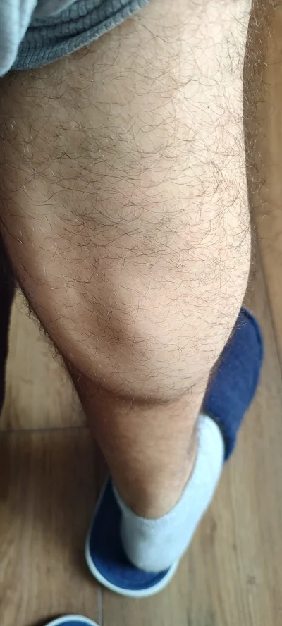 Lampartini - Cóż to może być, zgrubienie na łydce, zauważyłem przy napinaniu mięśnia....