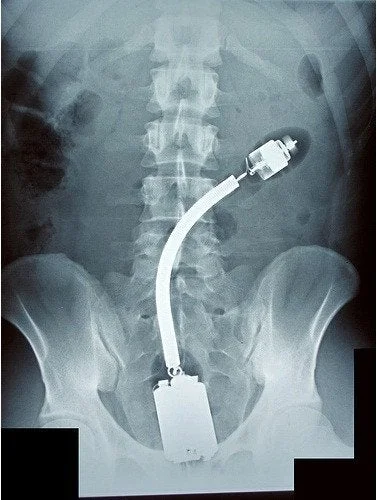 Neocaridina - #nocnazmiana
#ratownictwo #pogotowie #xray