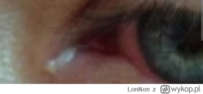 LonNon - mam już białą wydzielinę w oku cały czas od ponad roku od przesuszonych oczu...