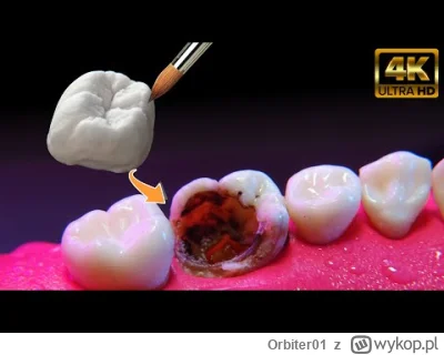 Orbiter01 - #dentysta #stomatologia  #medycyna  #lekarz Ekstremalna odbudowa zębów!  ...
