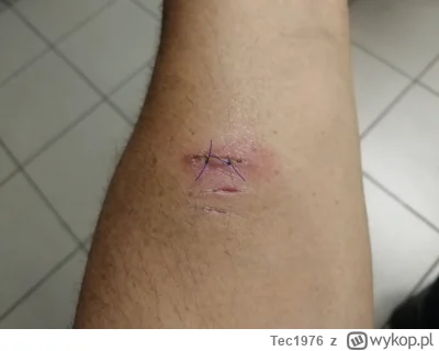 Tec1976 - @machinegunkelly_ Ja doostałem zakażenie gratis i nie obyło się bez antybio...