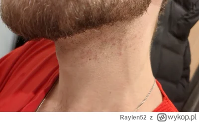 Raylen52 - Co zrobić aby nie pojawiala się taka wysypka po zgoleniu brody na szyi? Po...