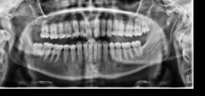 lunet - hej, bylem na przegladzie u dentysty, wszystko ok, zrobili mi zdjecie i zasta...