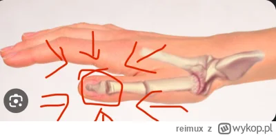 reimux - okolo dwa tygodnie temu w nienaturalny sposob wygial mi sie kciuk, pierwsze ...