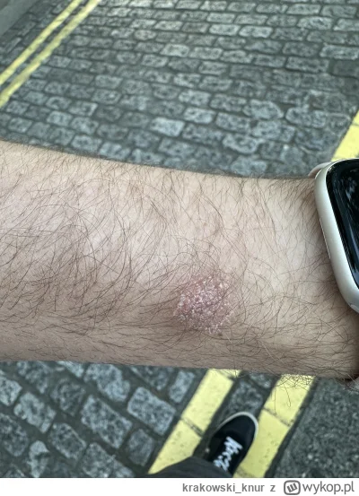 krakowski_knur - #medycyna 

Siemanko, jakiś czas temu pojawiło mi się na nadgarstku ...