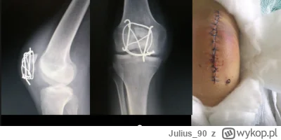 Julius_90 - #medycyna #hobby
Wieloodłamowe złamanie rzepki w prawym kolanie, zespolon...