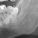 klintoniusz - Idę dziś po pracy do chirurga stomatologa usunąć ósemkę. Pierwsze rwani...