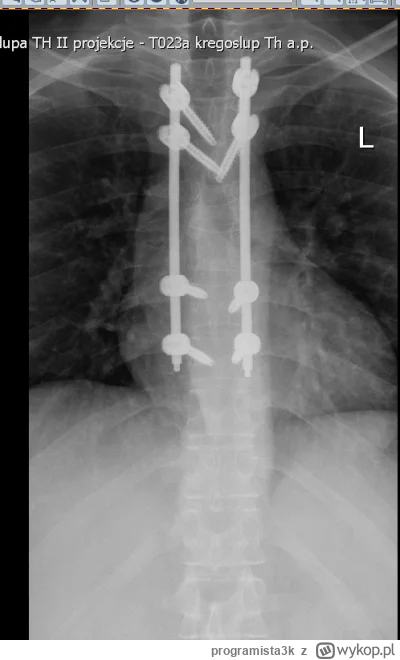 programista3k - @LonNon: #!$%@?. Trafiłem do szpitala wymiotując krwią okazało się że...