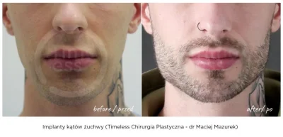 AlexBrown - A może by wszczepić implanty brody lub policzków?

#looksmaxing #looksmax...