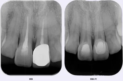affairz - czy leczenie kanałowe da się odwrócić? czy ząb wypełniony gutaperką da się ...
