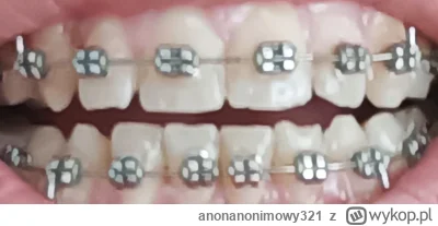 anonanonimowy321 - Progres po niecałych 4 miesiącach noszenia dolnego łuku aparatu do...