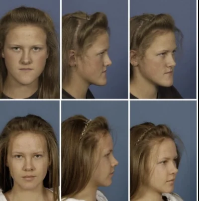 Dawid-01100 - #przegryw Cierpie na progenie to zniszczyło mi całe życie mam asymetrię...