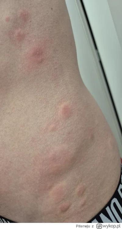 Piterwju - Czy to są ugryzienia przez pluskwe? W sumie poleżałem z 2h po pracy ba łóż...