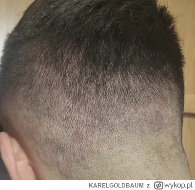 KARELGOLDBAUM - Mirki pomozcie co to mi sie zrobilo? #dermatologia #medycyna #lekarz