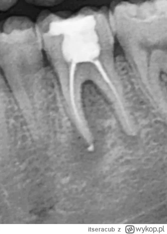 itseracub - 10 miesięcy temu miałem leczonego kanałowo zęba (dolna 6, ropień). Ząb ca...