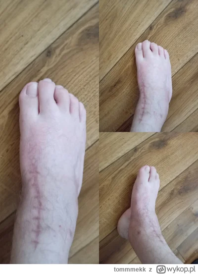tommmekk - Witam serdecznie Cały czas ćwiczę stopę.... Chodzę, masuje, stosuje różne ...