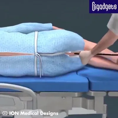 cheeseandonion - #kolonoskopia #marshaltown