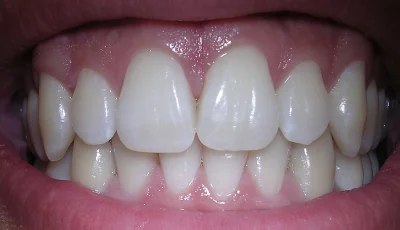 Ambiwalentnik - Ostatnio pisze o zębach bo dentyści są bezdradni. Najpierw bolała mni...