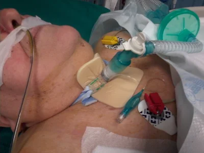 spsp01 - @CzarnyOwiec: Dziś wykonuje się zabieg tracheostomii i podłącza respirator.
