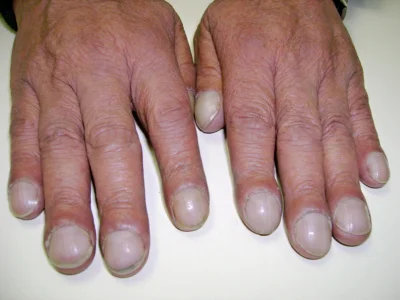kuba70 - @lubiempiwo: Taki kształt paznokci może wskazywać poważne choroby, zazwyczaj...