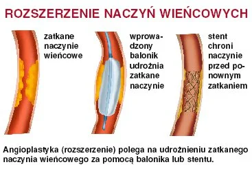 umiarkowany_ekstremista - @cheeseandonion: Procedura wydaje się lepsza niż balonikowa...