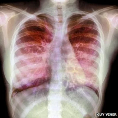 i.....r - Koronawirus nieodwracalnie uszkadza płuca.
https://www.wykop.pl/link/53648...