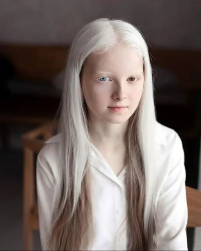 cheeseandonion - Młoda dziewczyna z albinizmem i heterochromią

#redditselected