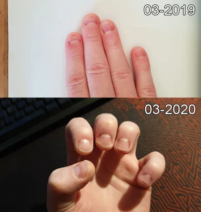 trzeci - Od 20 lat męczę się z problemem obgryzania paznokci, w moim przypadku było t...