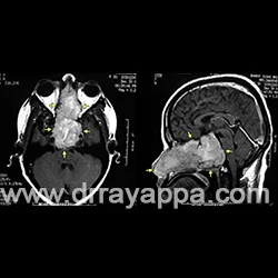 Strahl - @SkrytyZolw: @arti040: Zmiana rozrostowa.

 Giant cell tumour involving ent...