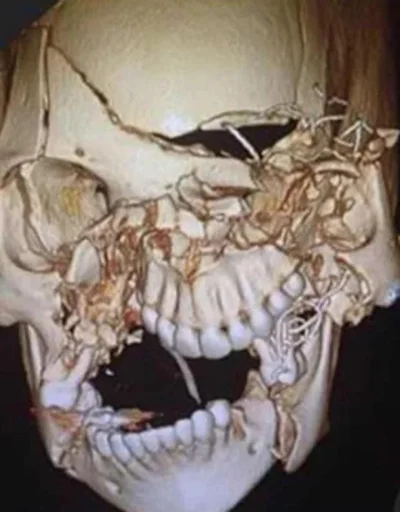 Kosciany - #ciekawostki #medycyna Rekonstrukcja czaszki kobiety po wypadku samochodow...