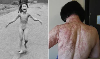 RUNDMC - Mała dziewczynka poparzona napalmem przez amerykańskie wojsko to - Kim Phuc ...