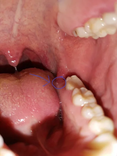 bmLq - #stomatologia Co to może być ta biała kropka? Boli przy dotyku językiem. Miałe...