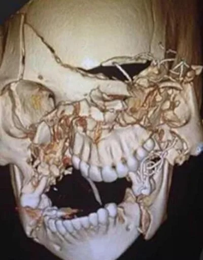Kosciany - Zapinajcie pasy

#ciekawostki #medycyna Rekonstrukcja czaszki kobiety po...
