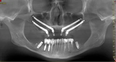 SkrytyZolw - Montowanie tych implantów to musi być czysta przyjemność ( ͡° ͜ʖ ͡°)

...