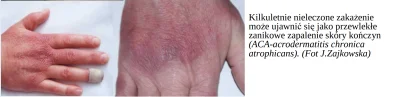 p.....k - Czy to co mam na dłoniach to Acrodermatitis chronica atrophicans?
Patrzę n...