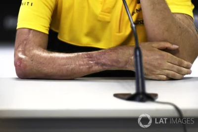 tusk - [PILNE] Wyciekło zdjęcie ręki Romana Grojeana bez opatrunku

#kubica #f1