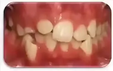 Galvay - aparat ortodontyczny w akcji (ʘ‿ʘ)
#ciekawostki #ortodoncja #medycyna #zeby...